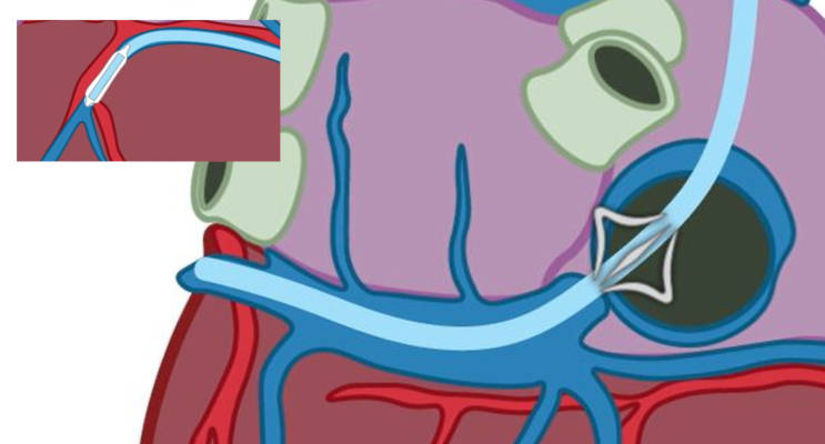 step-1-About-CathHelix