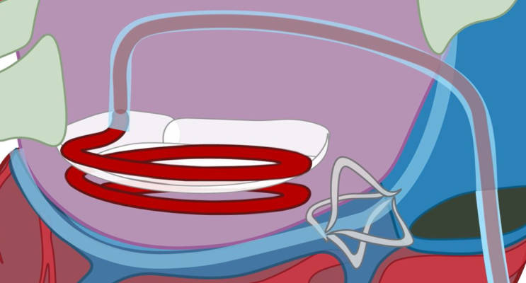 step-2-About-CathHelix