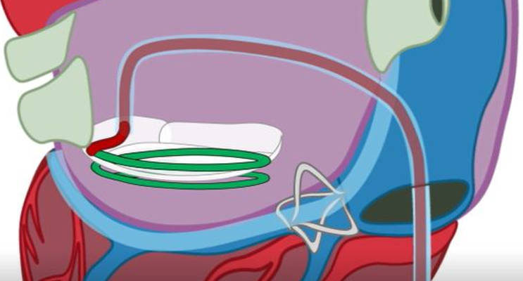 step-3-About-CathHelix