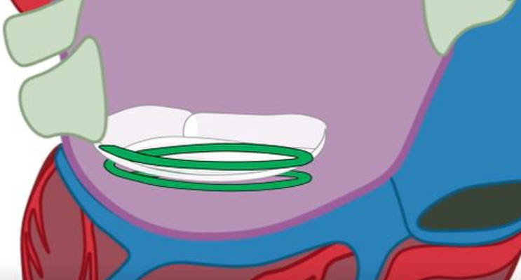 step-4-About-CathHelix